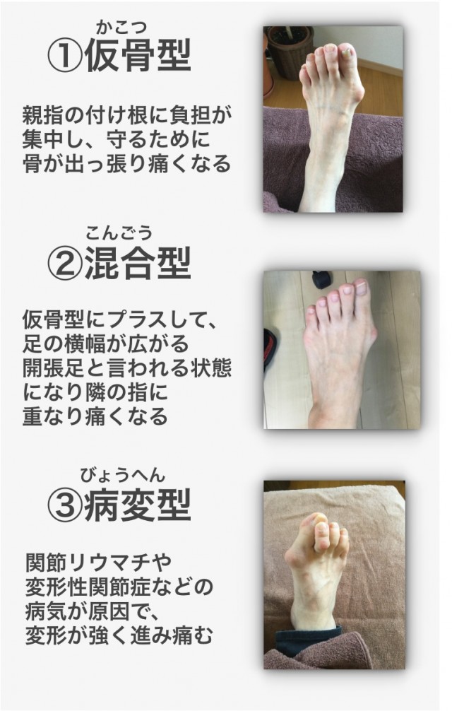 外反母趾（仮骨型・混合型・病変型）