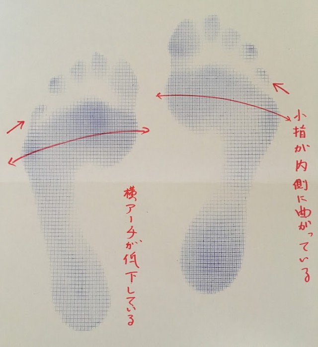 内反小肢足型