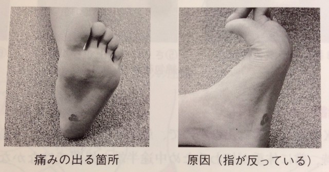 足底筋膜炎の痛みの場所