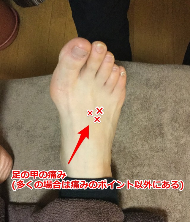 足の甲の痛みポイント