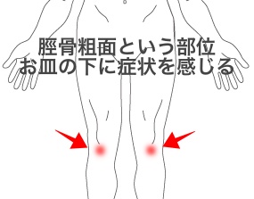 オスグッドの症状の位置