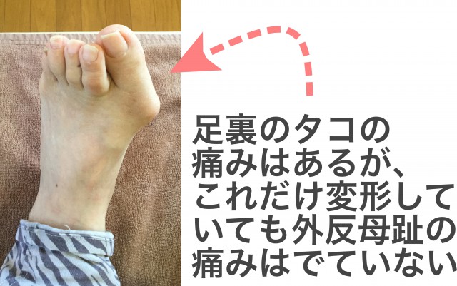 外反母趾痛みなし