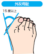 外反母趾