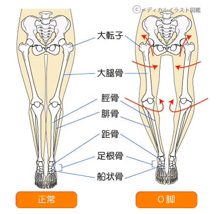 O脚