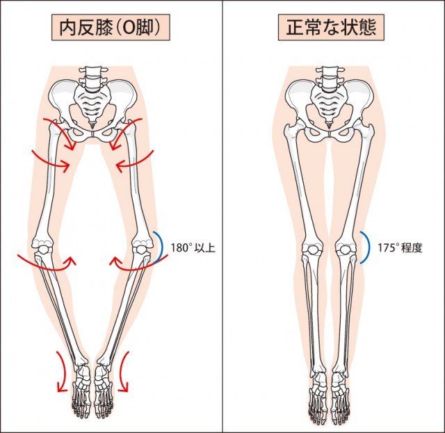 O脚