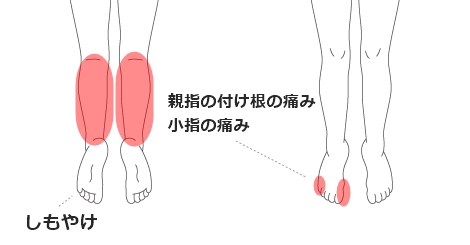 しもやけ・外反母趾・内反小肢