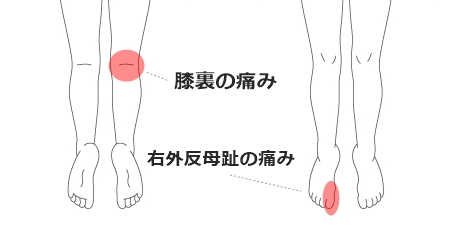 膝裏の痛み・右外反母趾の痛み