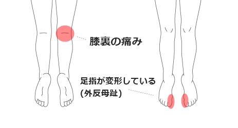 膝裏の痛み・外反母趾