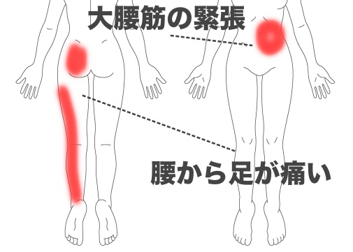 急 に 左 の 腰 が 痛い