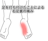 足底筋膜炎の症例３